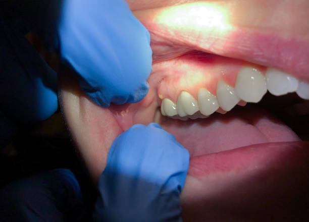 Best Emergency Dental Care for Broken or Chipped Teeth in Dousman, WI